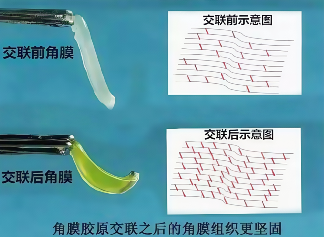 交联一手术前后